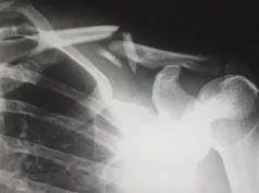 What to Do If You Suffer a Personal Injury While Traveling in the US