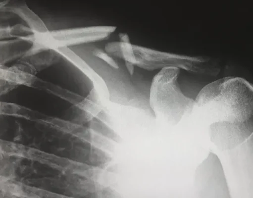 What to Do If You Suffer a Personal Injury While Traveling in the US